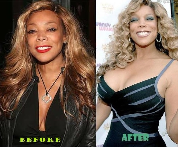 A picture of Wendy Williams before and after breast implants. 
